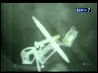 Aneh! Puluhan Benda Tajam Bersarang dalam Perut