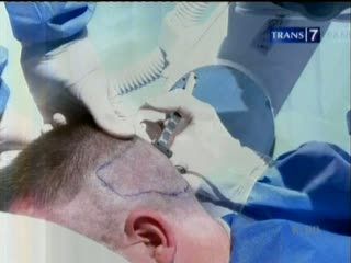Cangkok Rambut dengan Bantuan Robot