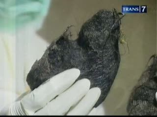 Gadis Pemakan Rambut Alami Gangguan Lambung