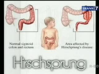 Hirchprung, Penyakit Pencernaan Pada Bayi