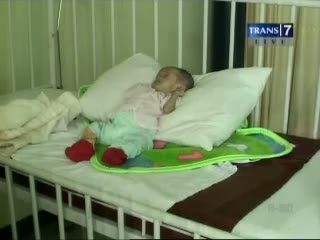 4 Balita Alami Gizi Buruk