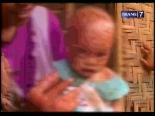 Derita Bayi dengan Penyakit Aneh