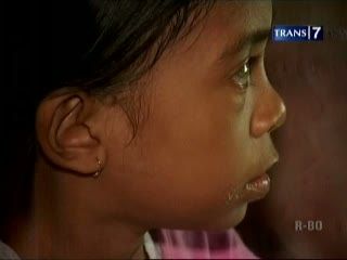 Tak Punya Katup Jantung, Bocah 11 Tahun Sering Nyeri