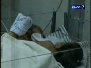Bayi Kembar Siam Jalani Operasi Jantung