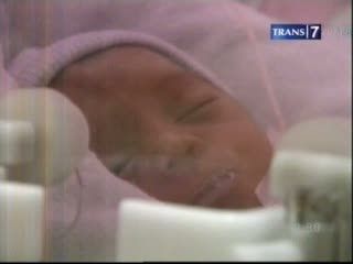Satu Bulan Dirawat, Kembar Dara Meninggal Dunia