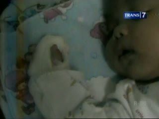 Orangtua bayi yang Diamputasi, Tuntut Tanggung Jawab RS