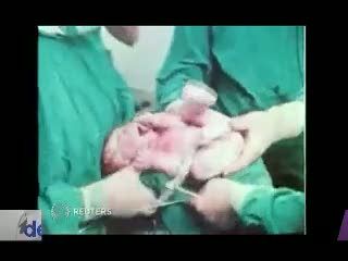 Robert Edwards, Penemu Teknik Bayi Tabung Wafat