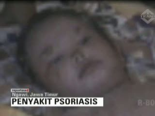 Bocah SD di Ngawi Alami Penyakit Langka