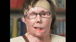 Korban Kekerasan, Ubah Wajah dengan Transplantasi