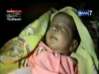 Derita Bayi Tanpa Anus