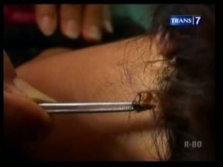  Terapi Sengat Lebah, Sembuhkan Berbagai Penyakit