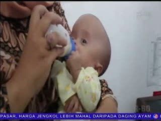 Bayi Hydrocephalus Ditinggal di RS