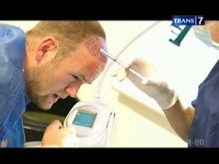 Lagi, Rooney Transplantasi Rambut