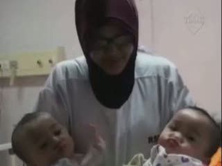 2 Kali Tertunda, Bayi Kembar Dempet Pinggul Segera Dipisahkan