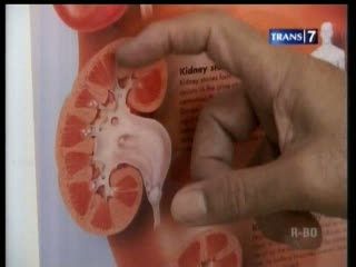 Hidup dengan Satu Ginjal Beresiko Tinggi