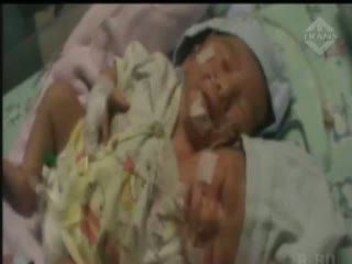 RS Bentuk Tim Tangani Bayi Kepala Dua