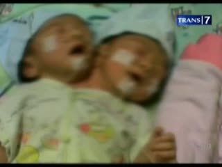 Tim Medis Observasi Bayi Berkepala Dua