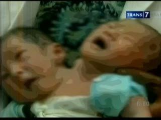 Bayi Berkepala Dua Tak Bisa Dipisahkan