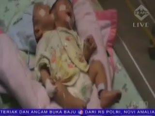 Kembar Siam Majenang Dipasangi Selang Pernapasan