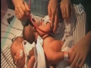 Bayi Dempet Pantat Terlahir Selamat