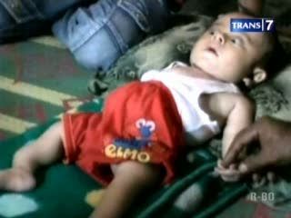 Bayi Penderita Tulang Rapuh Dirawat Seadanya