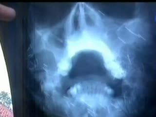 Benda Asing dalam Tubuh, Fenomena Medis atau Mistis?
