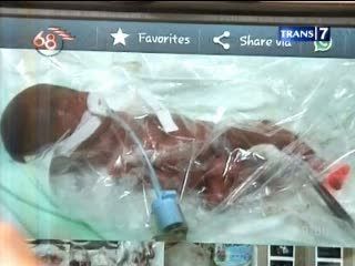 Bayi Kembar Lima Lahir Selamat