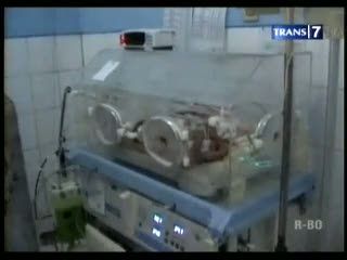 Bayi Kembar Siam Dempet Dada dan Perut