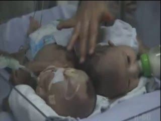 Bayi Kembar Siam Dempet Pantat Jalani Operasi Hari Ini