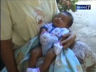 Diduga Korban Malpraktek, Kaki Bayi Patah