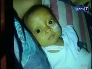 Bayi Kelainan Hati Membutuhkan Bantuan