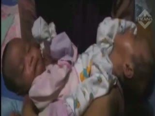 Memprihatinkan, Bayi Lahir Dempet Hanya Miliki 2 Kaki