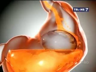 Menelan Balon, Metode Baru Menurunkan Berat Badan