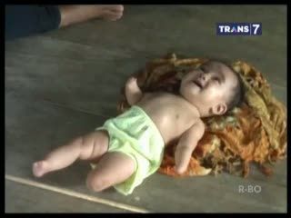 Bayi Tanpa Tangan dan Kaki Menanti Dermawan