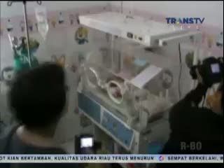 Bayi Dua Wajah yang Malang