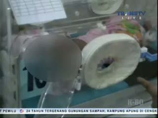 Bayi Berwajah Dua Akan Melakukan Operasi
