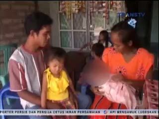 Bayi Berwajah Dua Akan Dibawa ke Jakarta