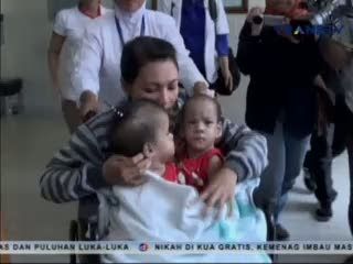 Operasi Bayi Kembar Siam asal Banyuwangi