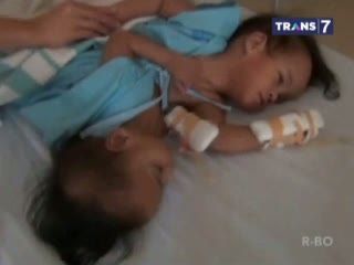 100 Dokter Tangani Operasi Pemisahan Bayi Kebar Siam