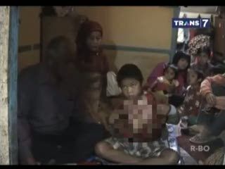 Bocah Disiram Spirtus, Alami Cacat Permanen Akibat Luka Bakar