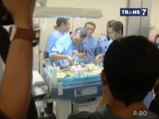 Bayi Kembar Siam Asal Ponorogo di Pindah ke Surabaya