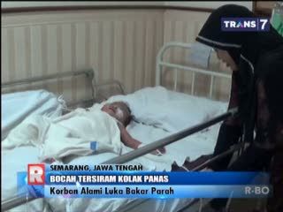 Tersiram Kolak Panas, Bacah 2 Tahun Alami Luka Bakar Parah
