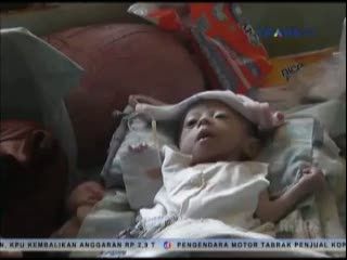 Bayi 3 Bulan Ini Alami Gizi Buruk dan Kelainan Paru-paru