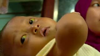 Bayi Ini Butuh Rp 900 Juta untuk Sembuhkan Penyakitnya