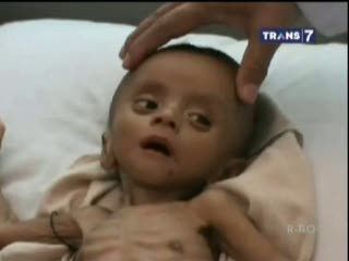 Kasihan, Gizi Buruk Sebabkan Balita Ini Hanya Berbalut Kulit