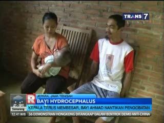 Bayi Hydrocephalus Butuh Bantuan