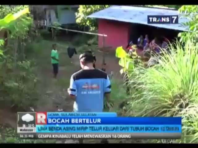 Bocah di Gowa Keluarkan Telur dari Tubuhnya