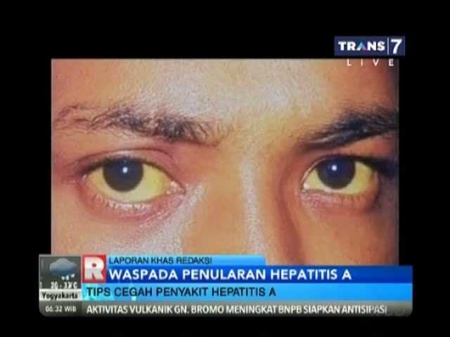 Kenali Gejala Hepatitis A