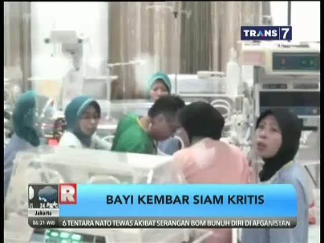 Kondisi Bayi Kembar Siam Bernama Ivon Memburuk