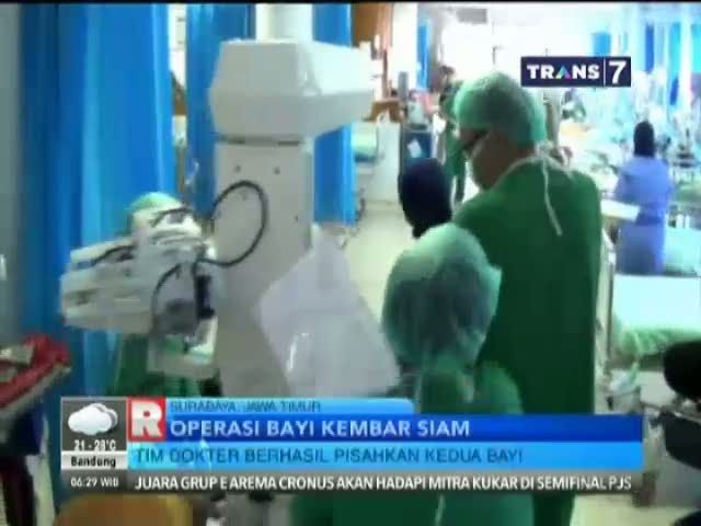 Nyawa Salah Satu Bayi Kembar Siam Tidak Terselamatkan